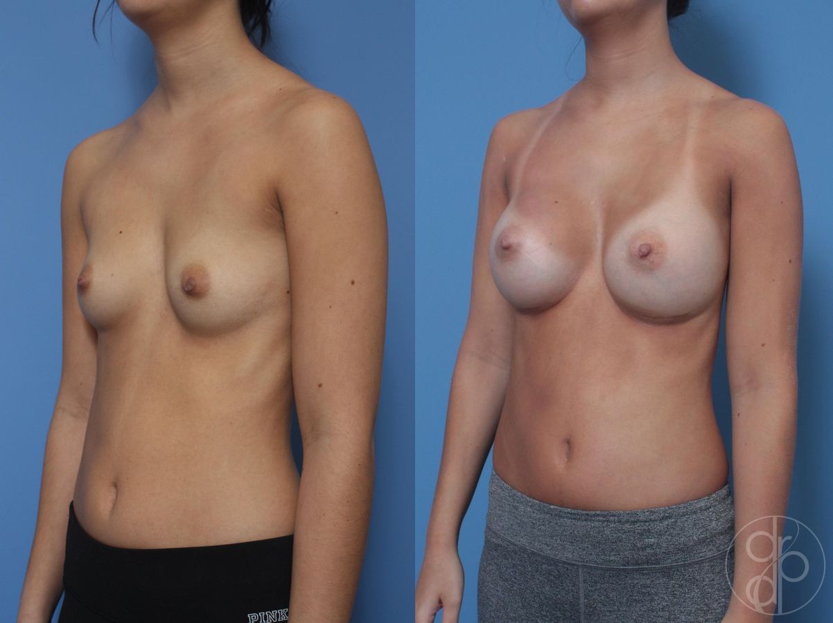 Before and after Breast Augmentation case 29815 - Angle 4