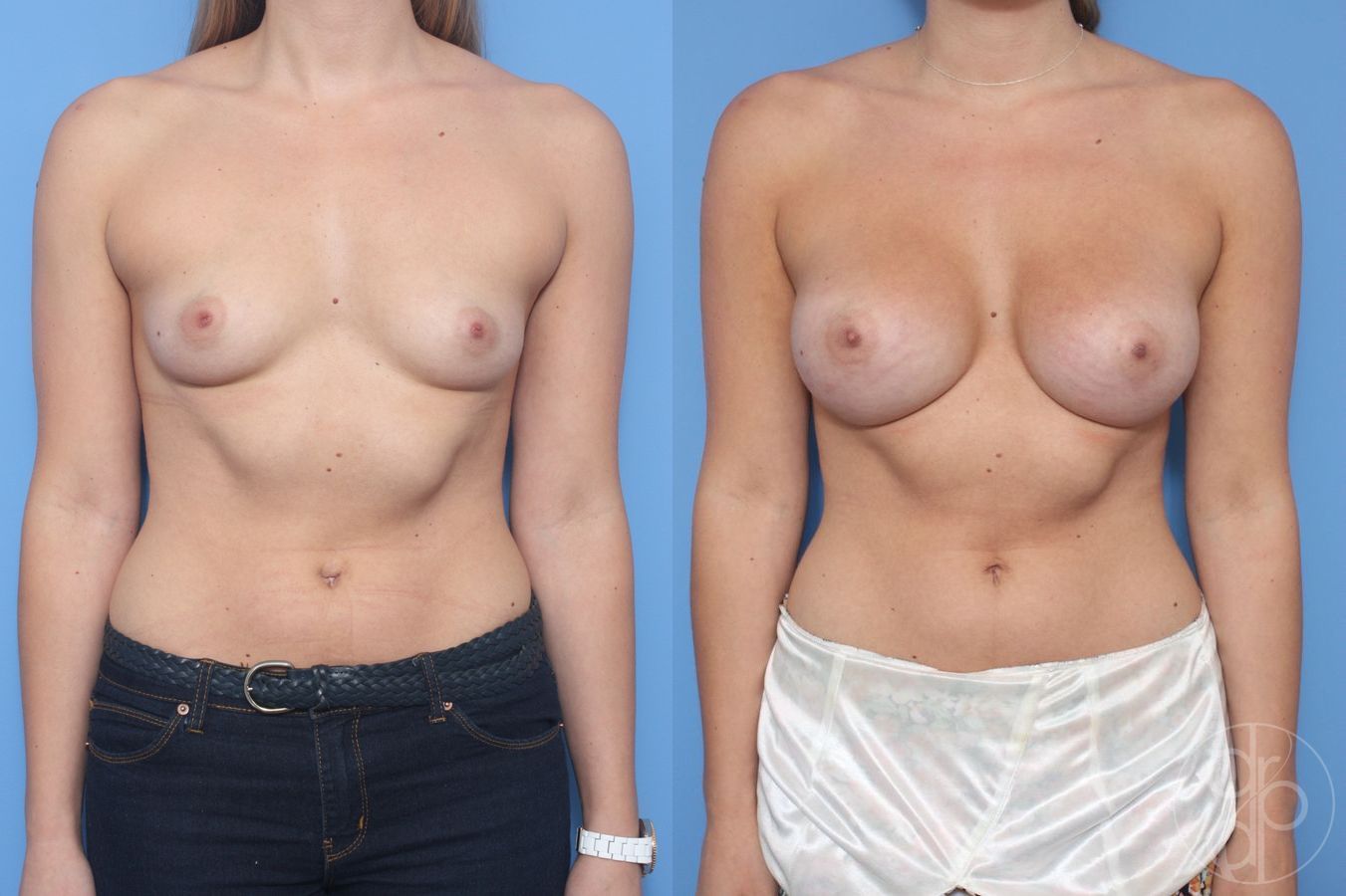 Before and after Breast Augmentation case 29913