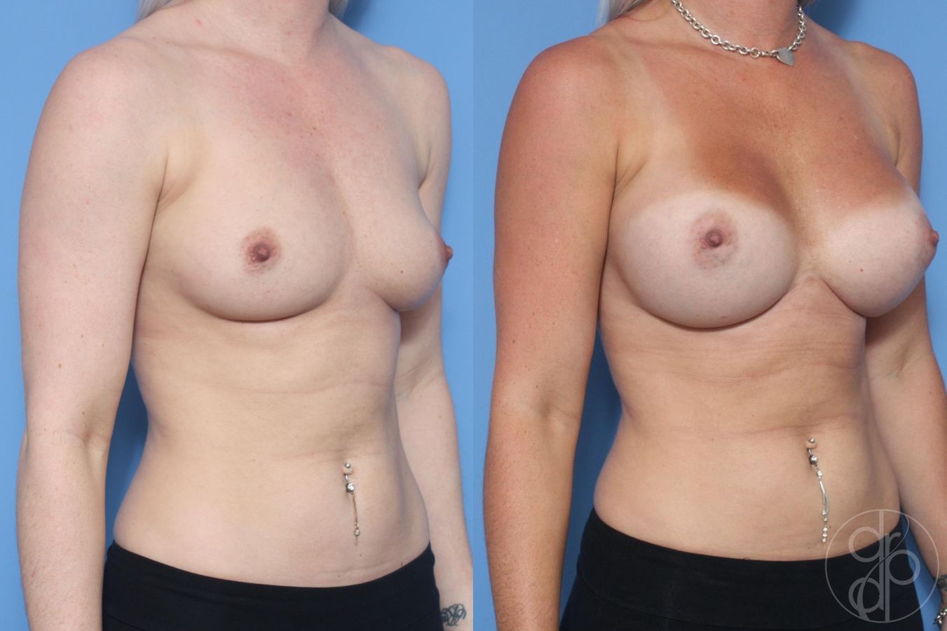 Before and after Breast Augmentation case 29616 - Angle 3