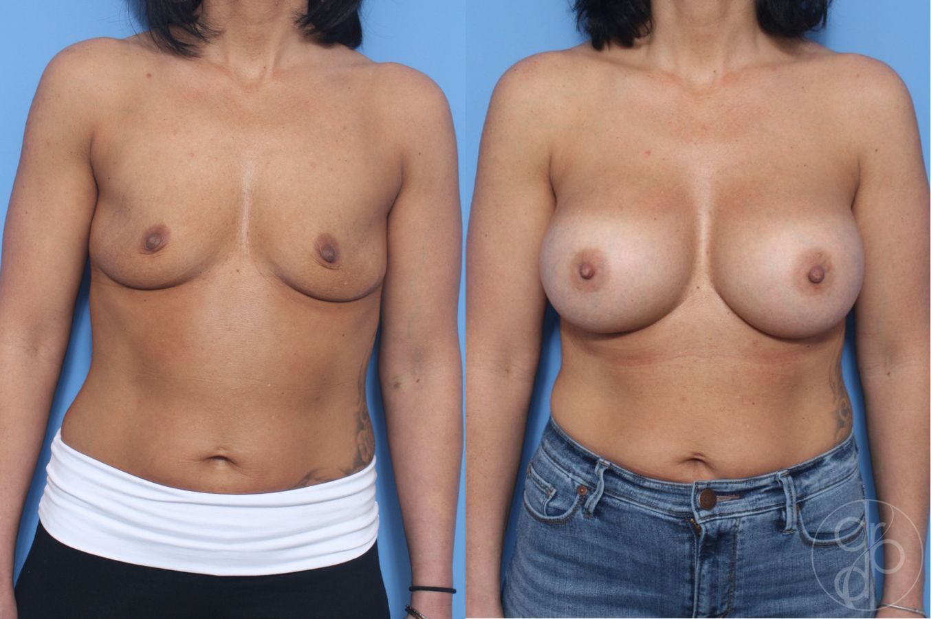 Before and after Breast Augmentation case 29600