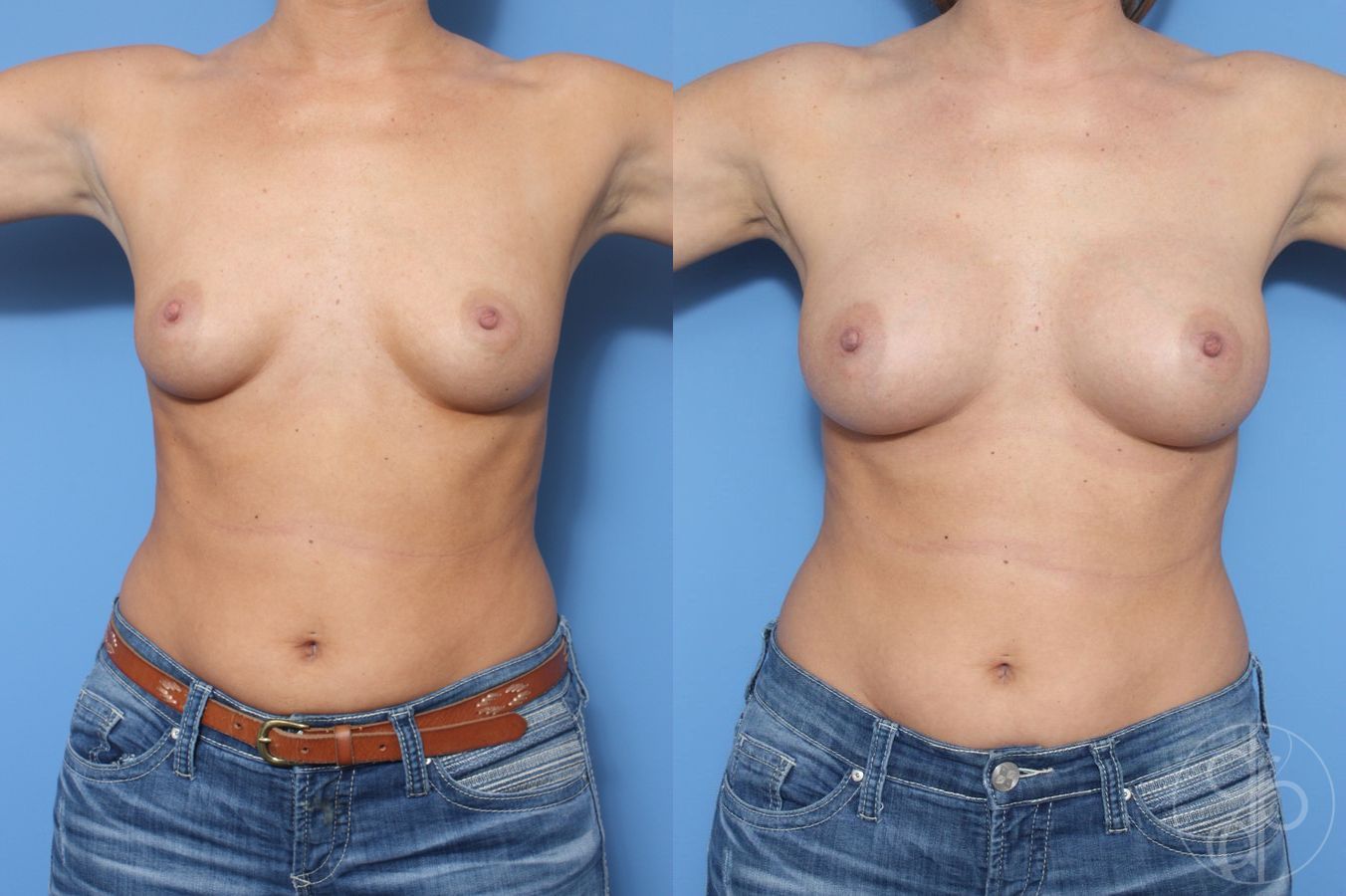Before and after Breast Augmentation case 29919