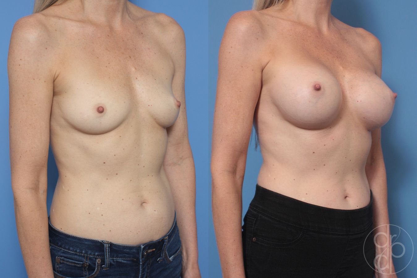 Before and after Breast Augmentation case 29959 - Angle 2