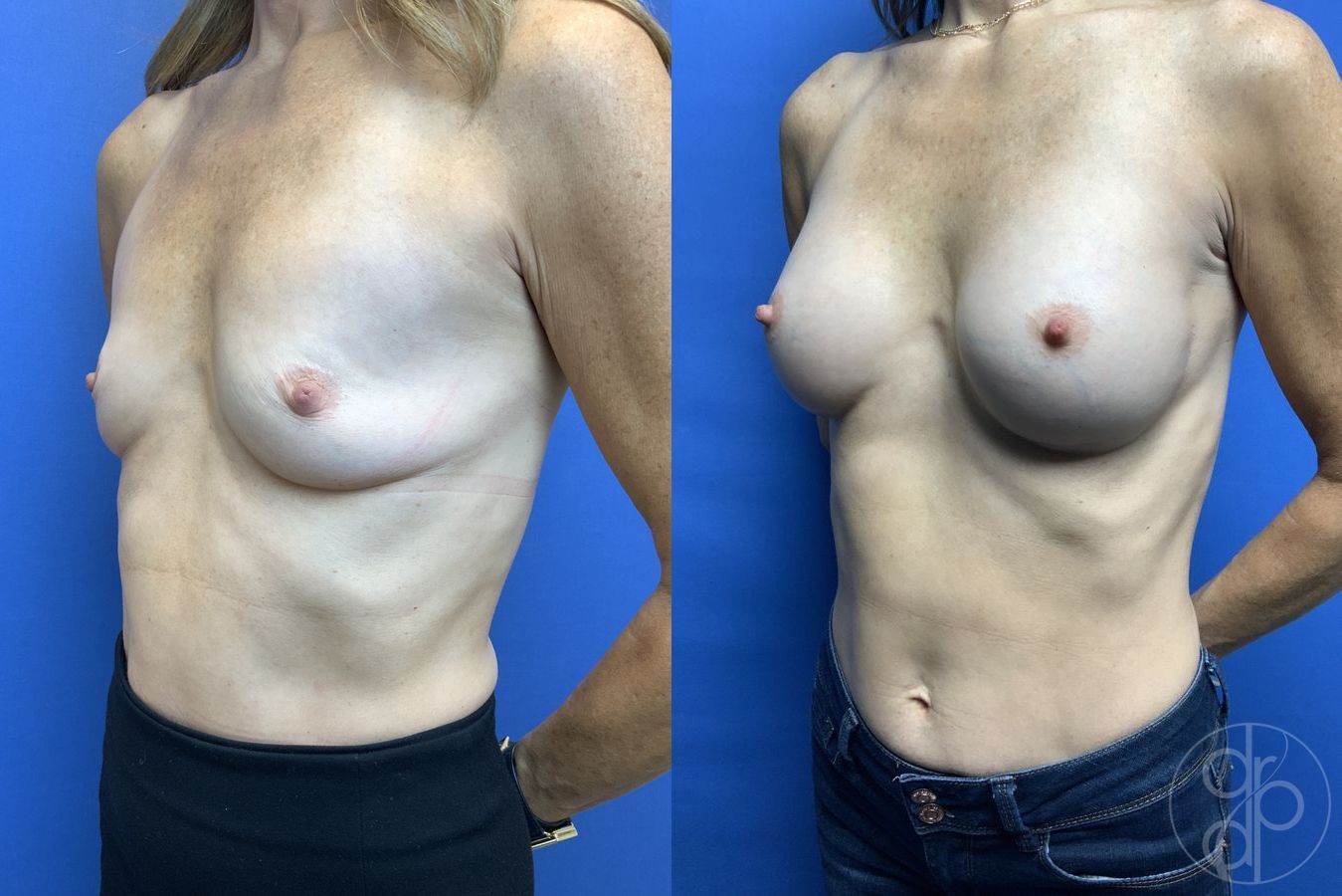 Before and after Breast Augmentation case 29923 - Angle 3