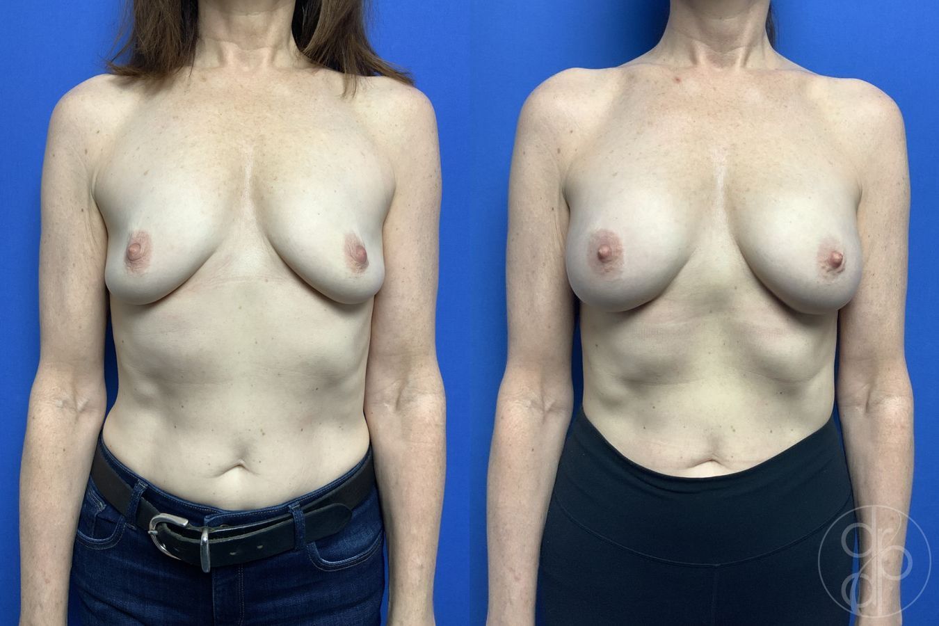 Breast Augmentation - Case 431