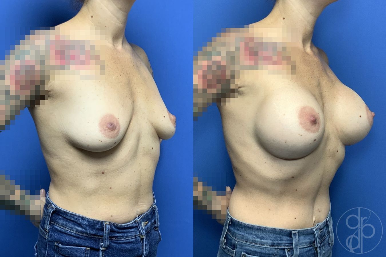 Before and after Breast Augmentation case 29929 - Angle 3