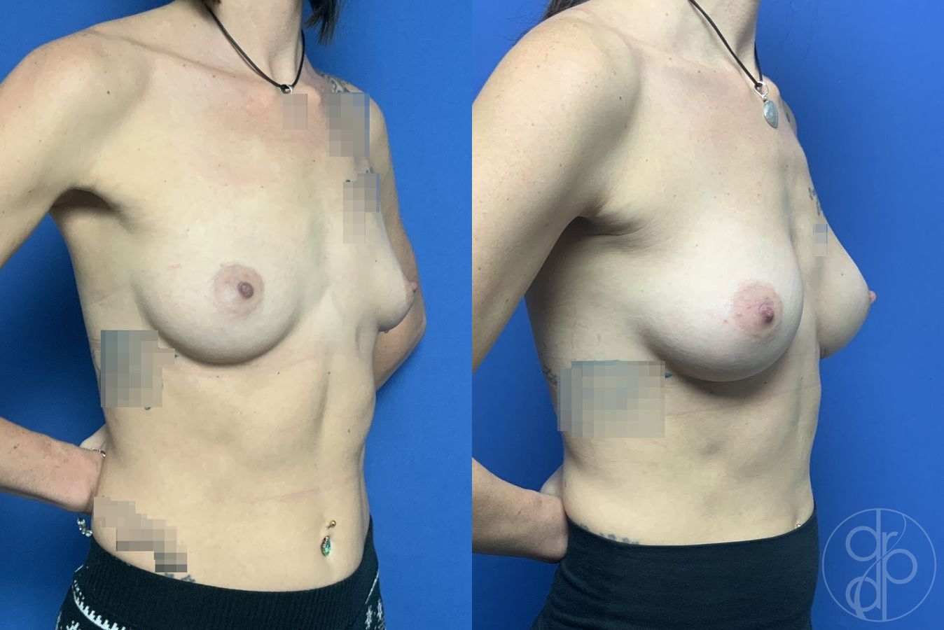 Before and after Breast Augmentation case 29877 - Angle 2