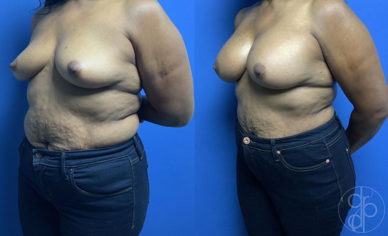 Breast Augmentation - Thumbnail 3