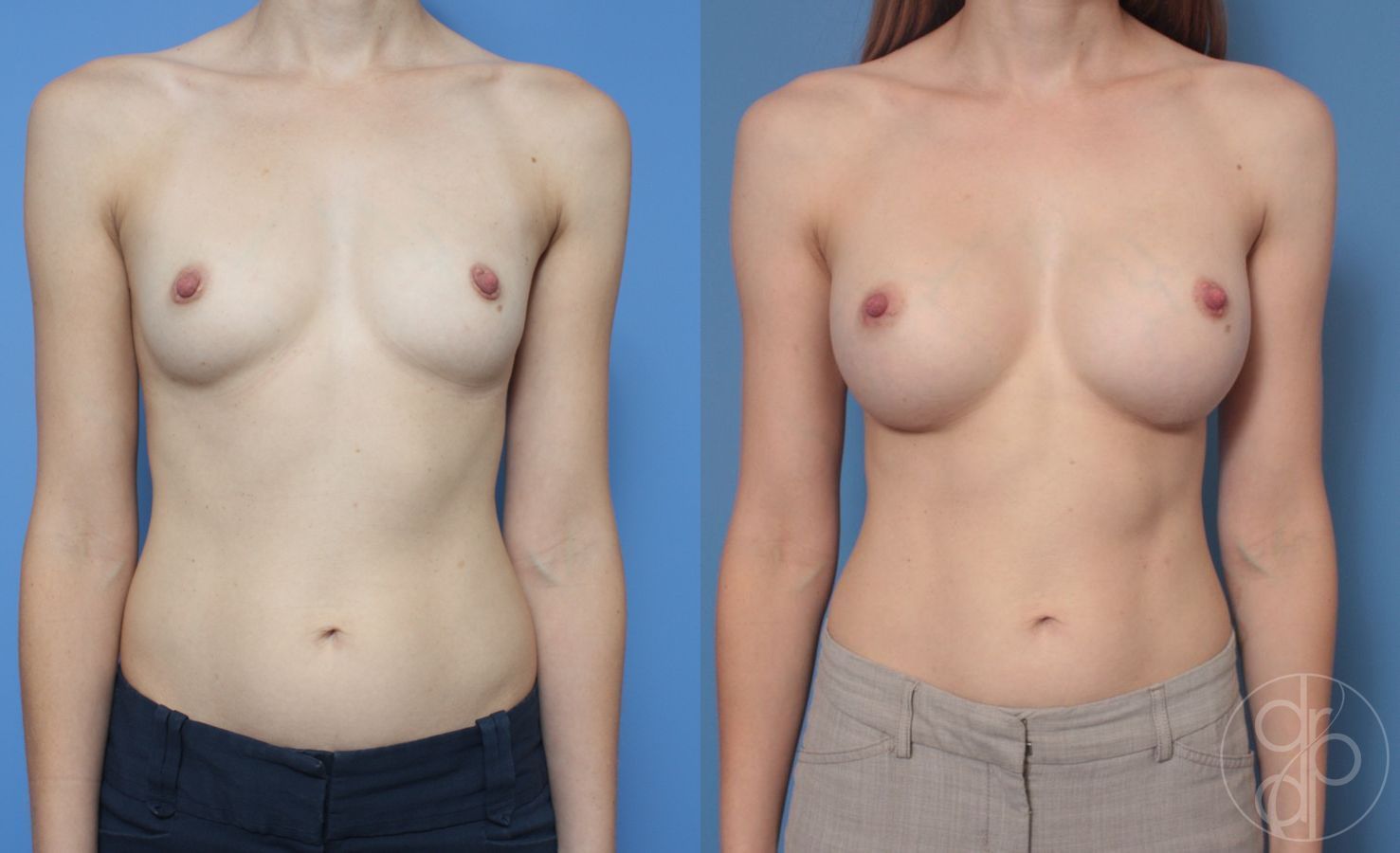 Before and after Breast Augmentation case 29909