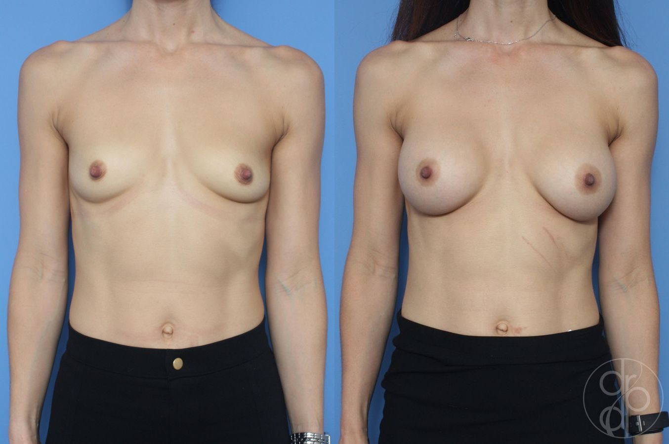 Before and after Breast Augmentation case 29795