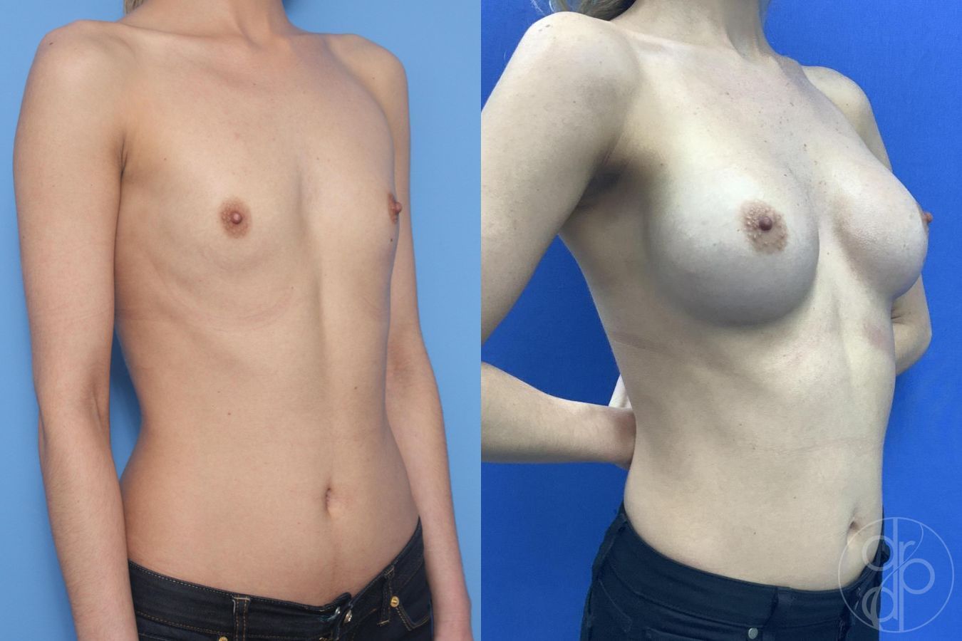 Before and after Breast Augmentation case 29935 - Angle 4
