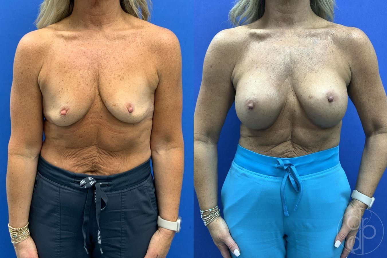 Before and after Breast Augmentation case 29657