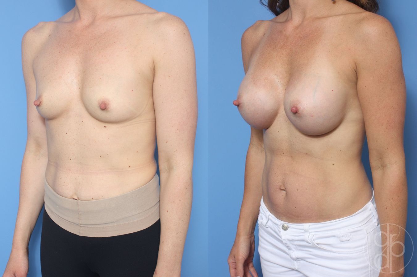 Breast Augmentation - Thumbnail 3