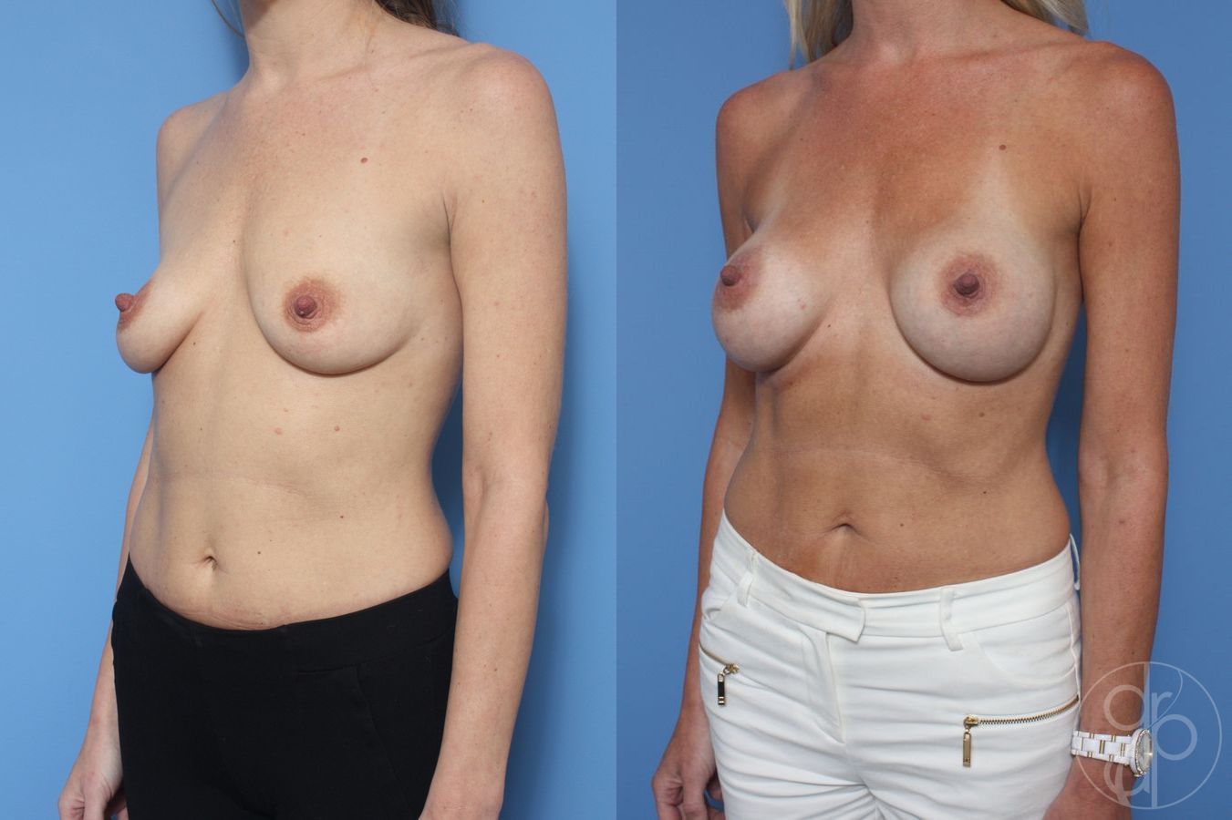 Before and after Breast Augmentation case 29938 - Angle 3