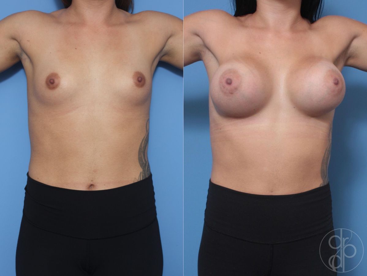 Before and after Breast Augmentation case 29819 - Angle 2
