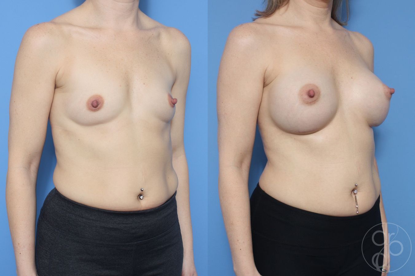 Before and after Breast Augmentation case 29927 - Angle 2