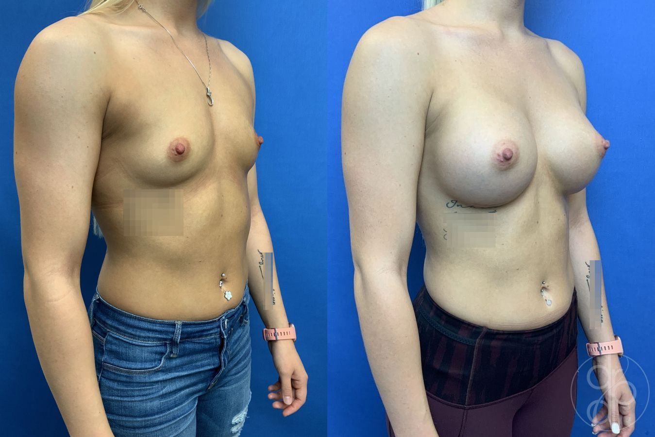 Breast Augmentation - Thumbnail 2