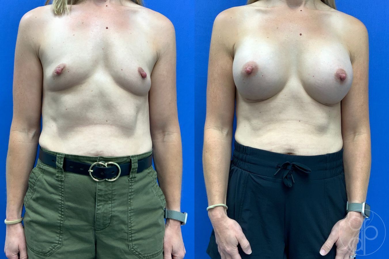 Before and after Breast Augmentation case 49410