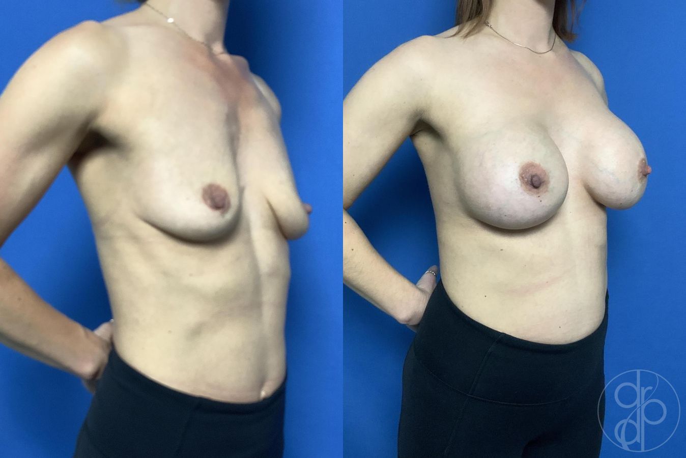 Before and after Breast Augmentation case 29999 - Angle 2