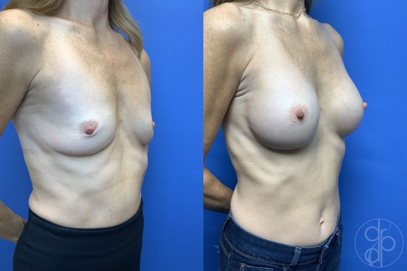 Before and after Breast Augmentation case 29923 - Angle 2
