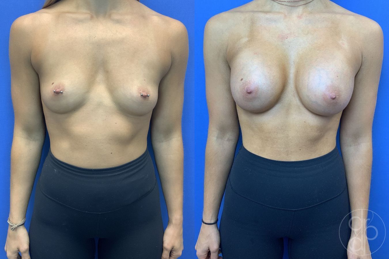 Before and after Breast Augmentation case 29941