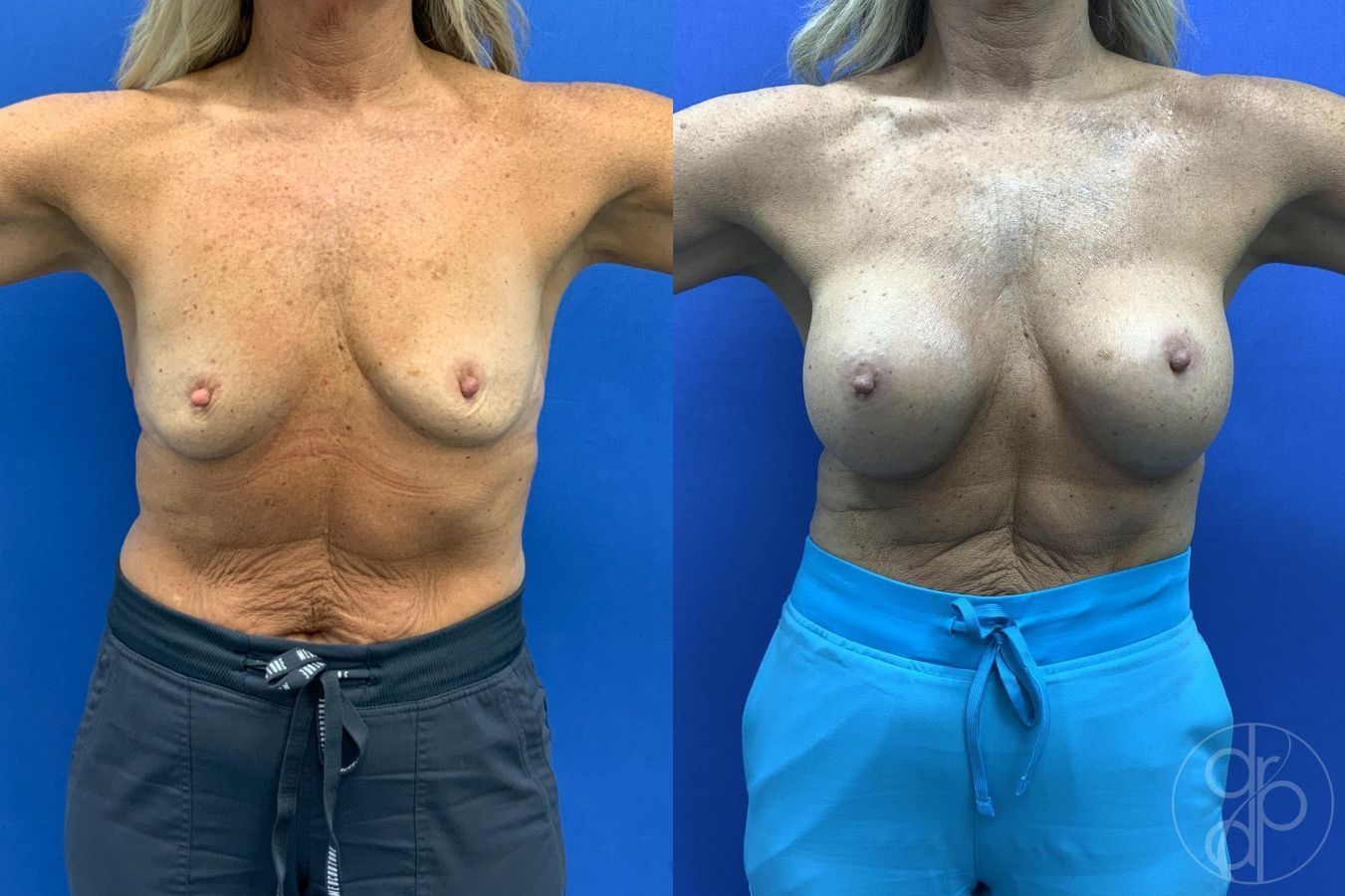 Before and after Breast Augmentation case 29657 - Angle 2