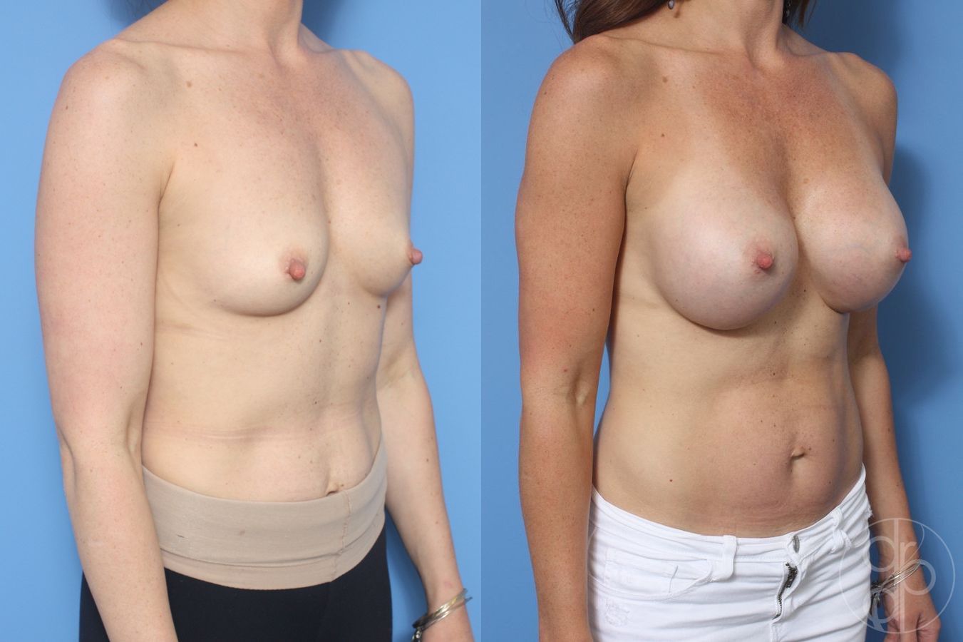Breast Augmentation - Thumbnail 2