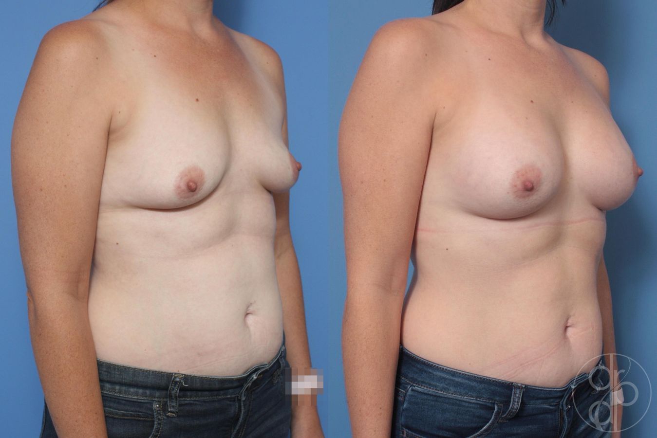 Before and after Breast Augmentation case 29998 - Angle 3
