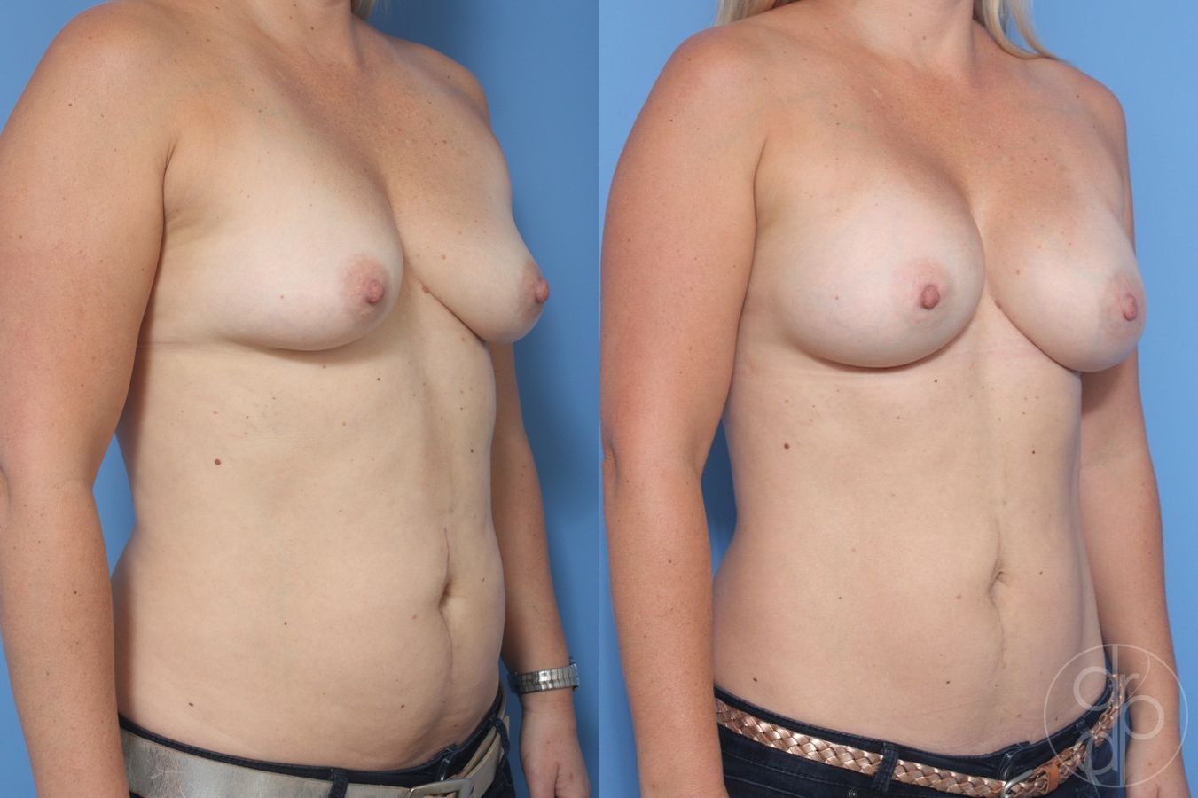Before and after Breast Augmentation case 29946 - Angle 2