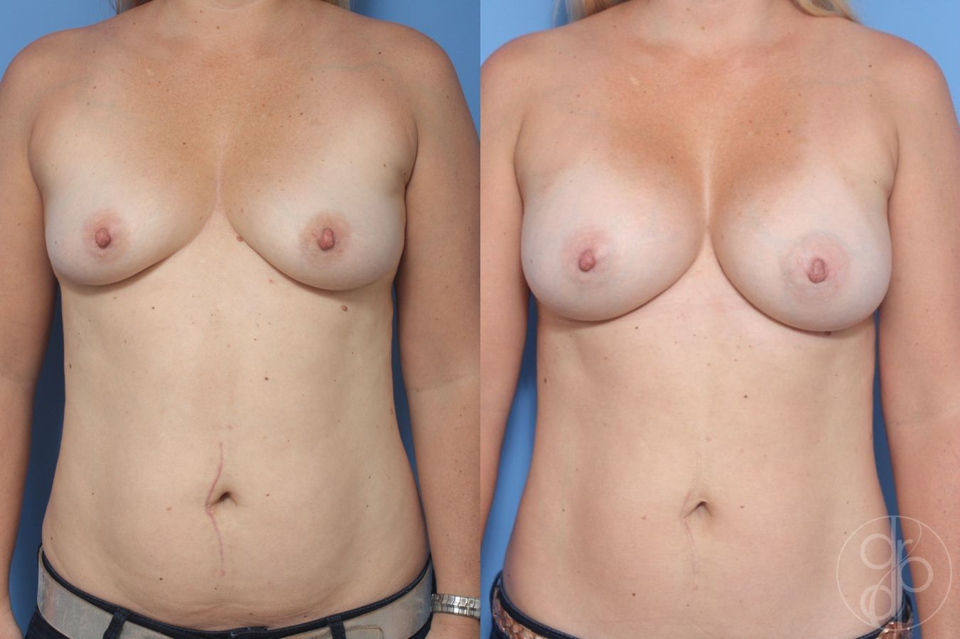 Before and after Breast Augmentation case 29946