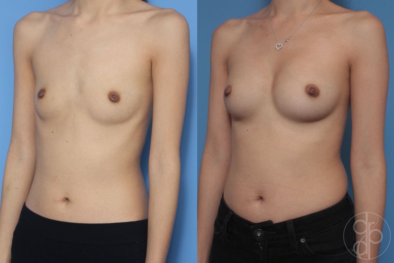 Before and after Breast Augmentation case 29833 - Angle 2