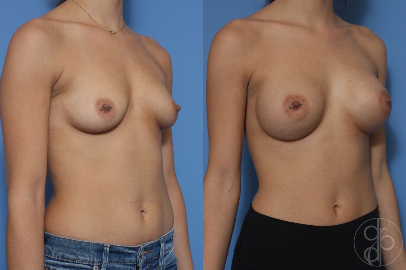 Before and after Breast Augmentation case 29944 - Angle 3