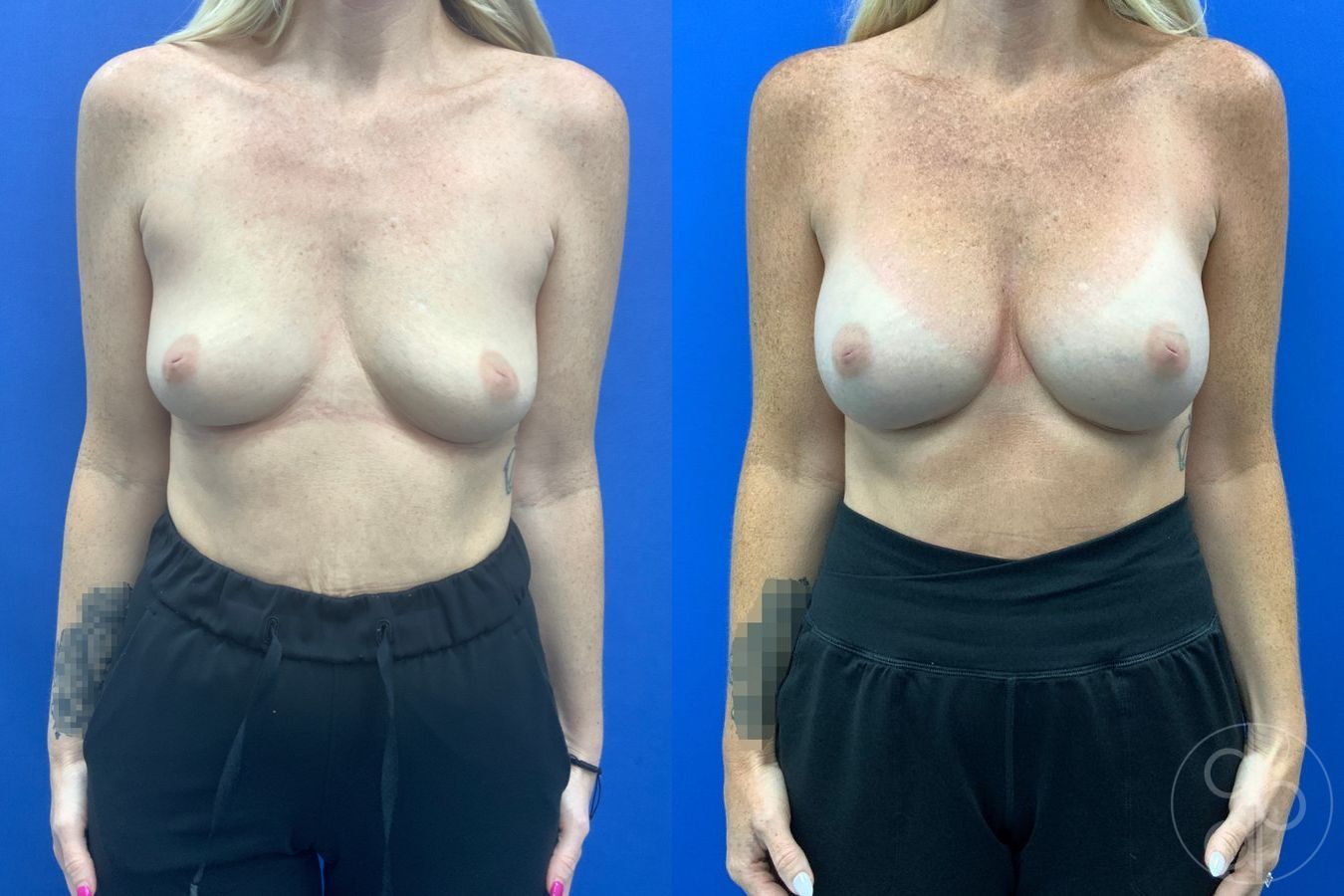 Before and after Breast Augmentation case 46357