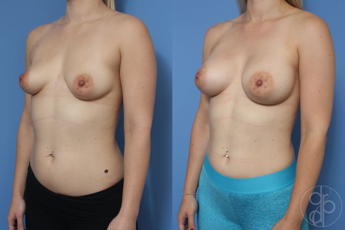 Breast Augmentation - Thumbnail 3