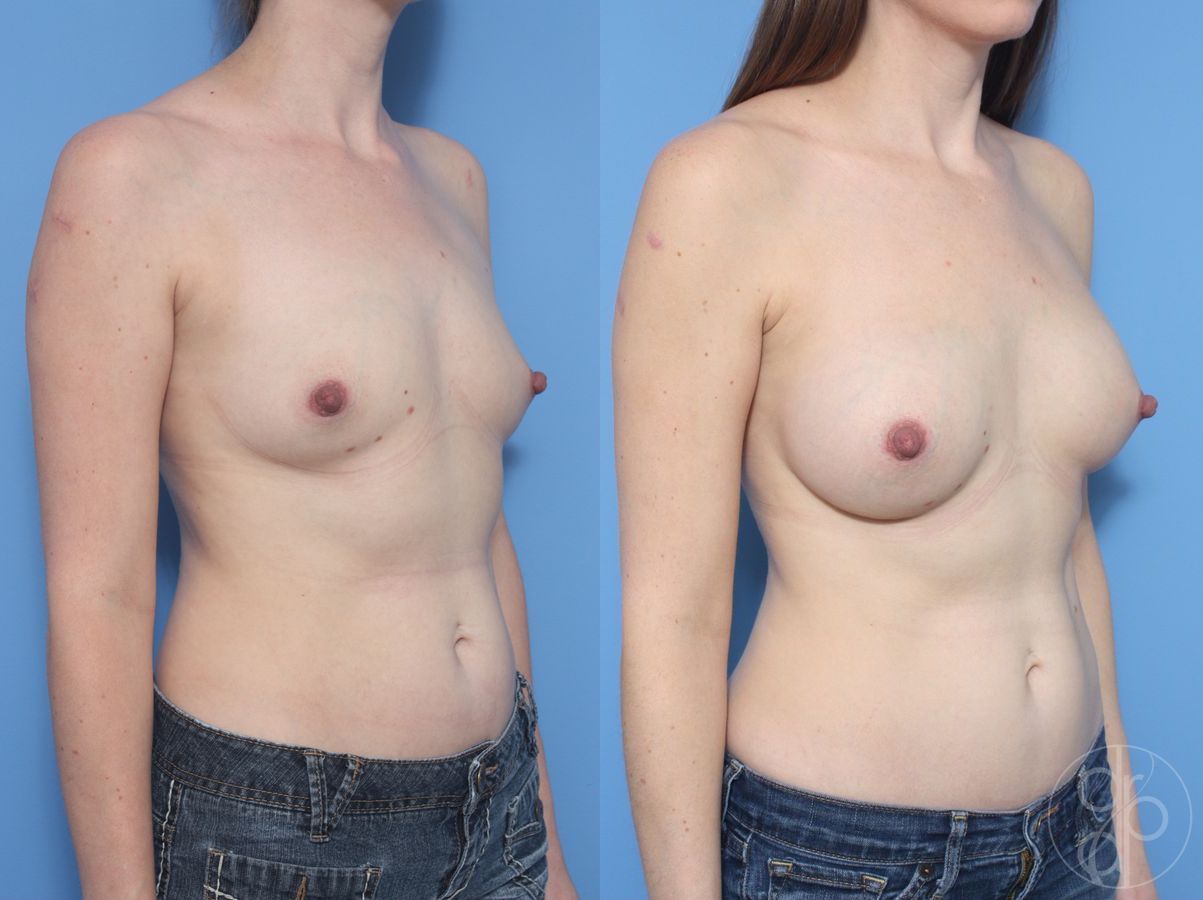 Before and after Breast Augmentation case 29950 - Angle 2