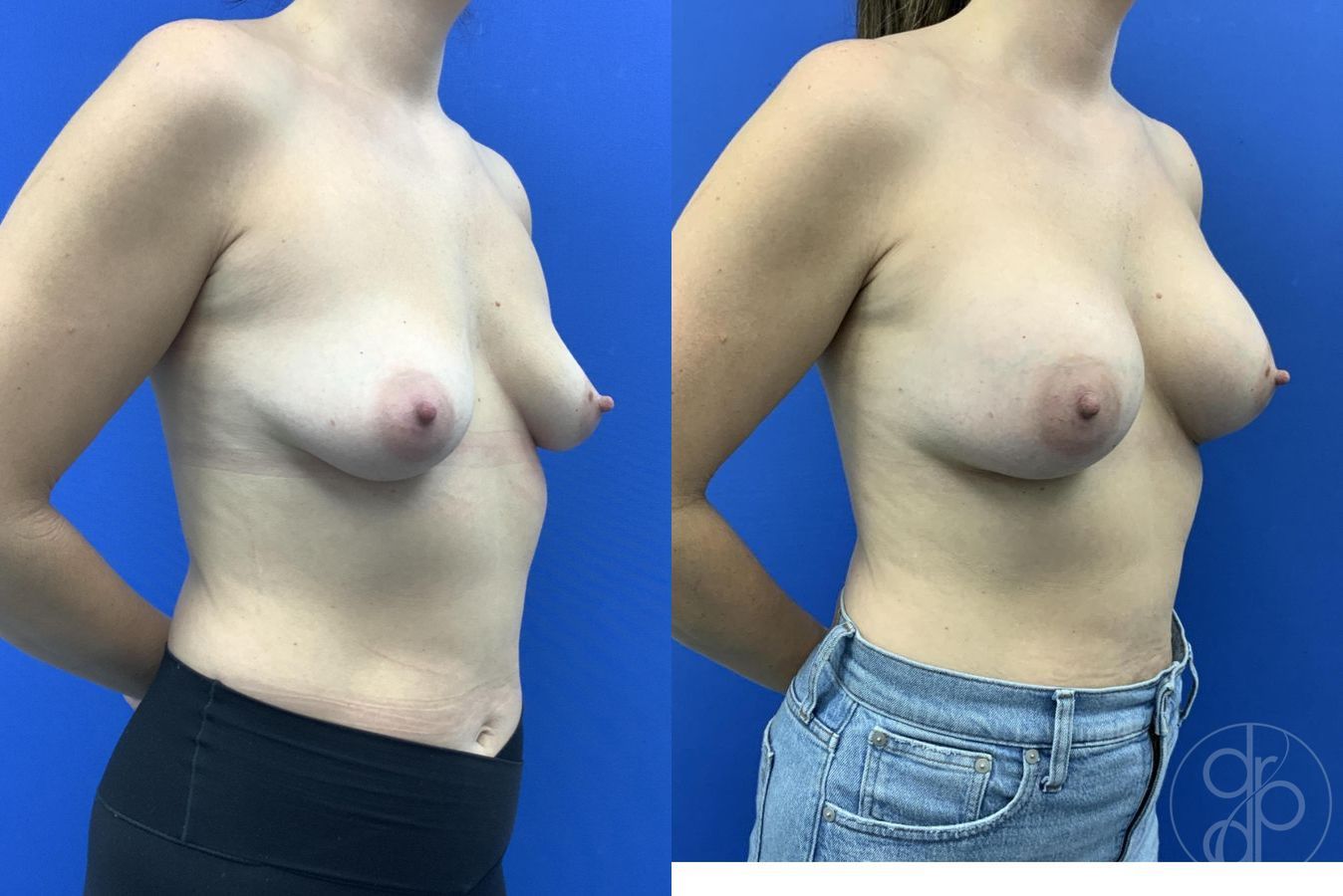 Before and after Breast Augmentation case 29655 - Angle 4