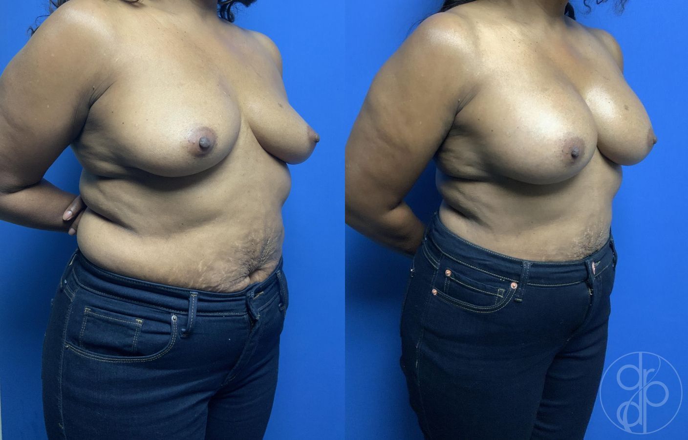 Breast Augmentation - Thumbnail 2