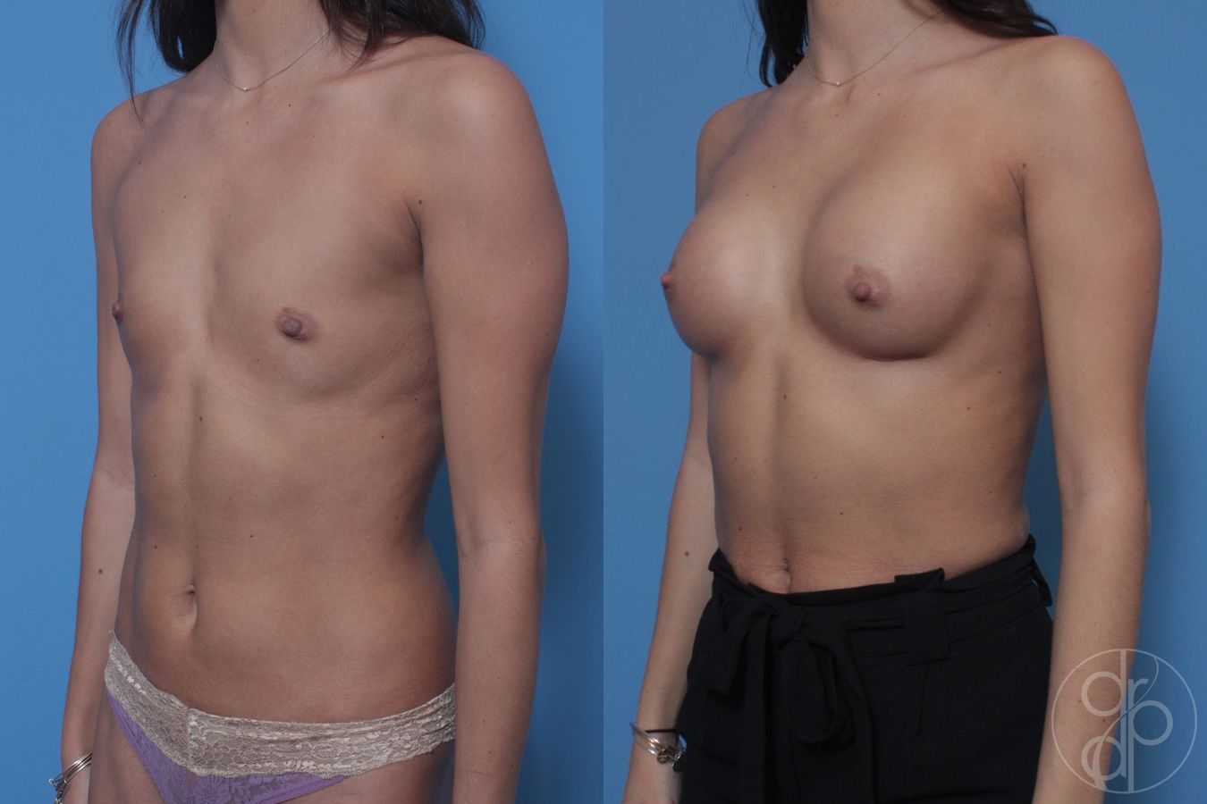 Before and after Breast Augmentation case 29924 - Angle 3