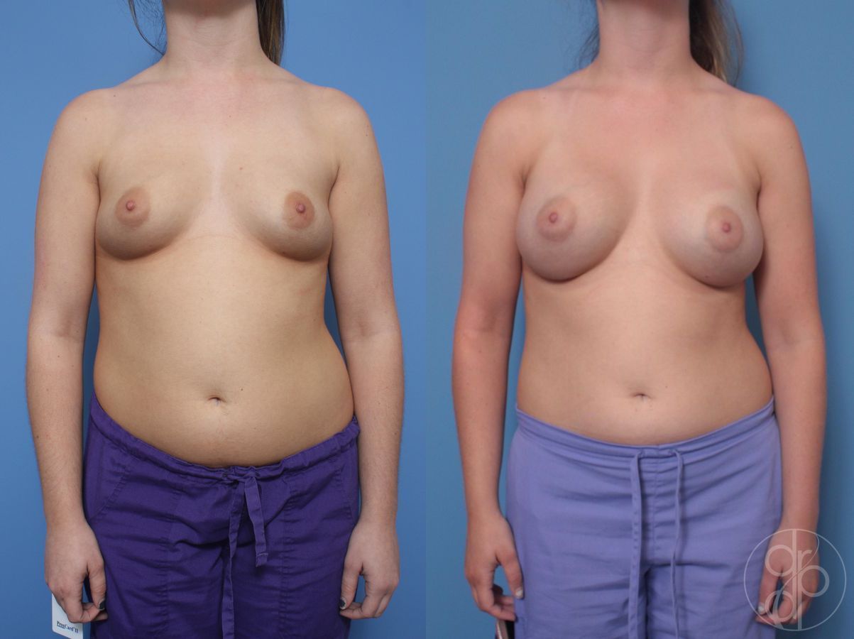 Breast Augmentation - Case 453