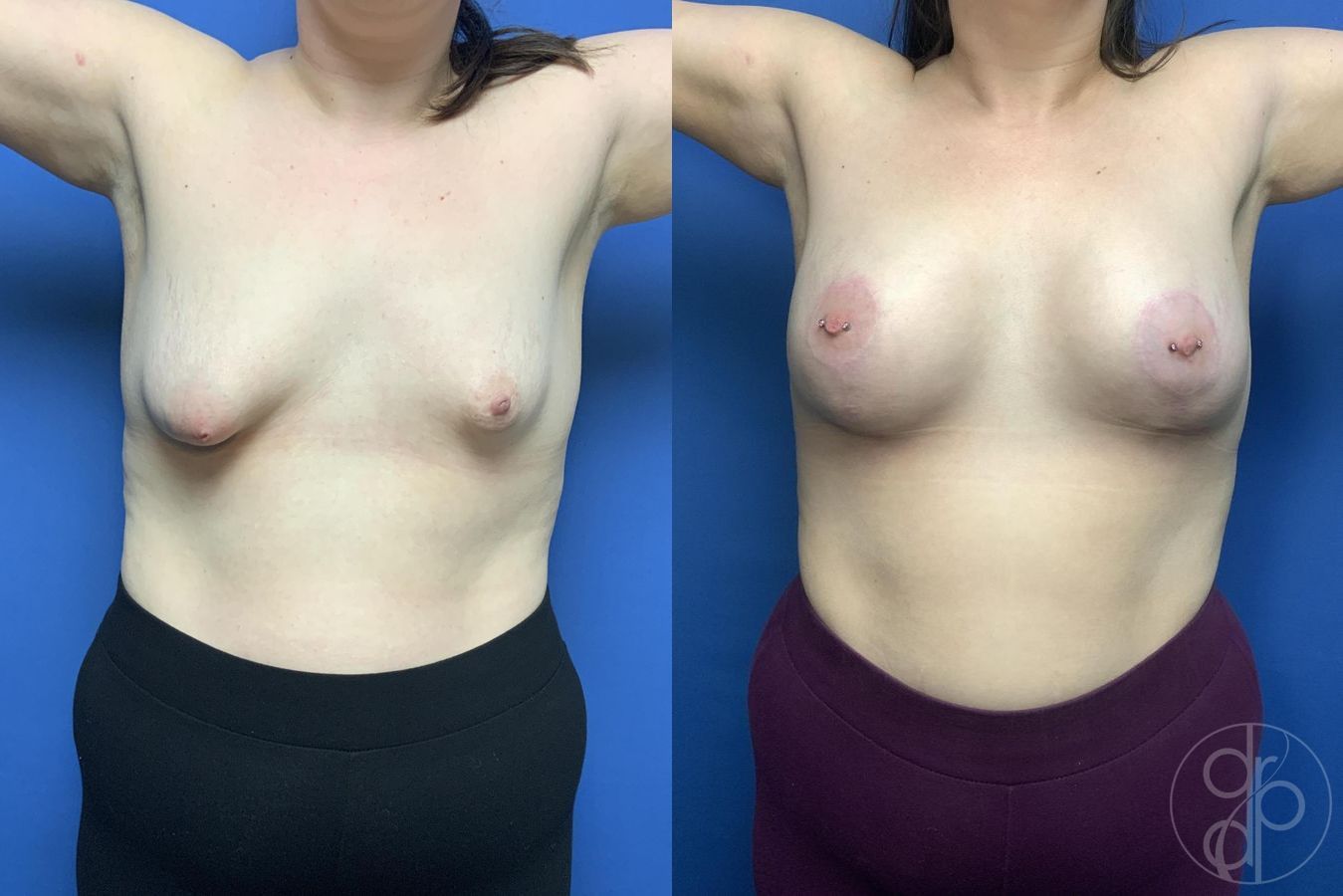 Before and after Breast Augmentation case 29979 - Angle 2