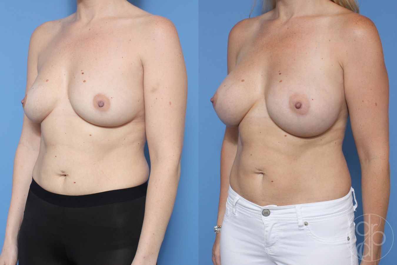 Before and after Breast Augmentation case 29949 - Angle 3