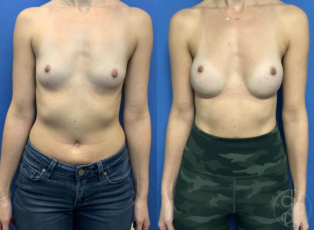 Before and after Breast Augmentation case 29788