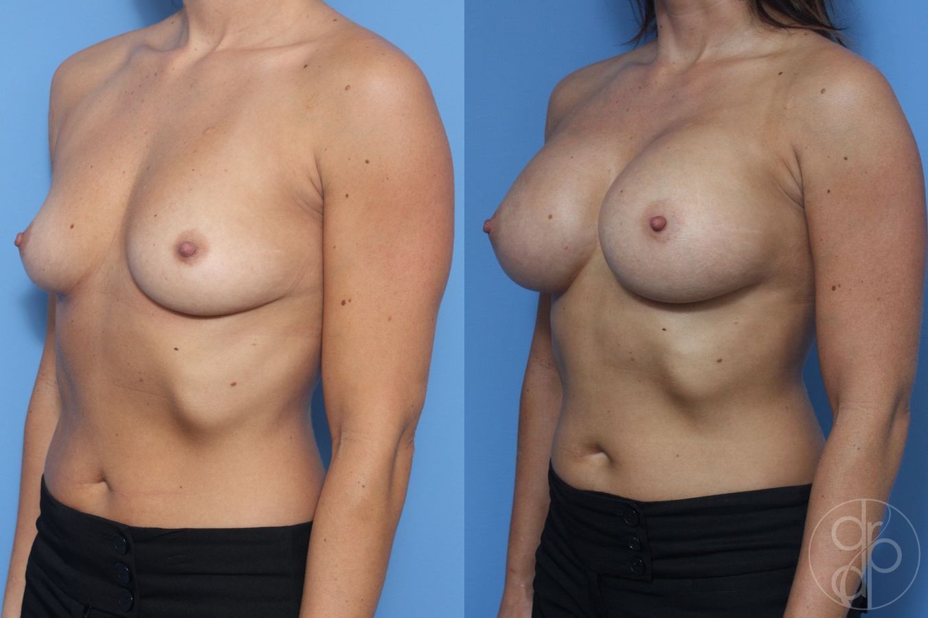 Before and after Breast Augmentation case 29947 - Angle 2