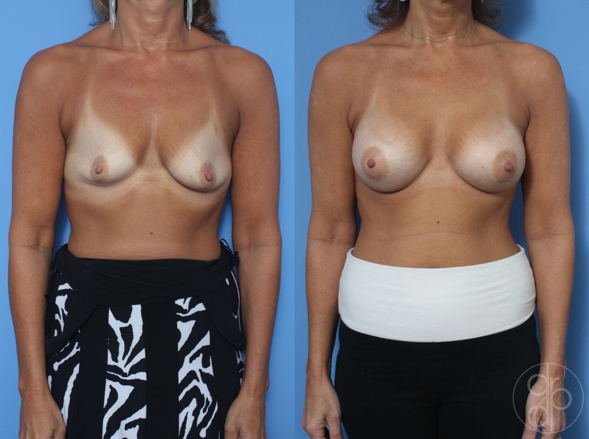 Before and after Breast Augmentation case 29823