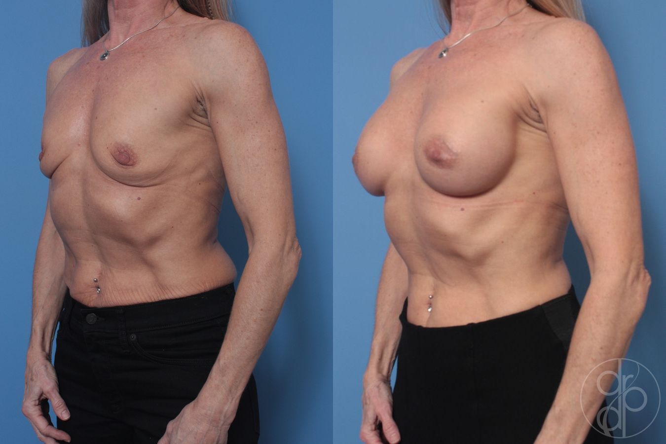 Before and after Breast Augmentation case 29925 - Angle 3