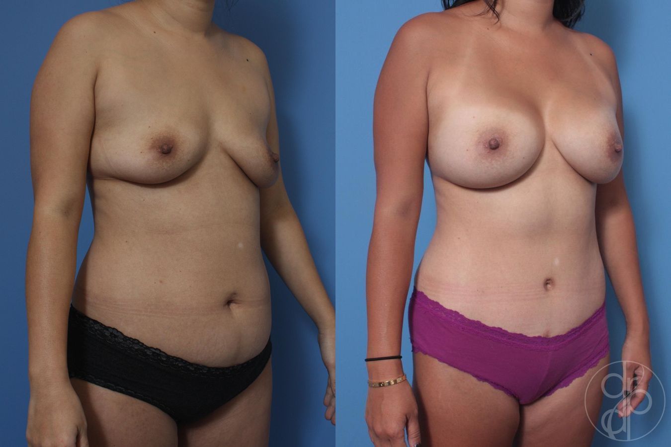 Before and after Breast Augmentation case 29715 - Angle 3