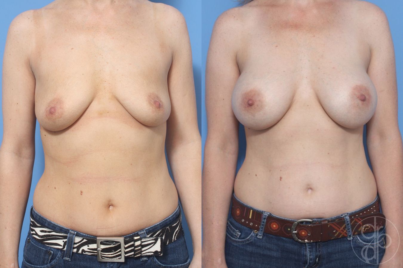 Before and after Breast Augmentation case 29932