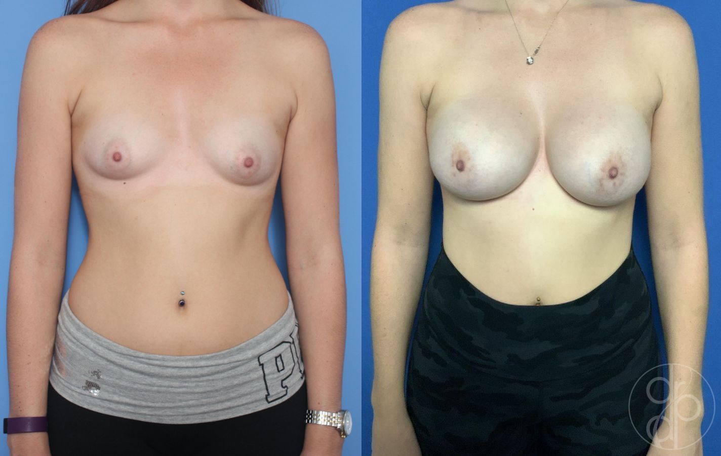 Before and after Breast Augmentation case 29787