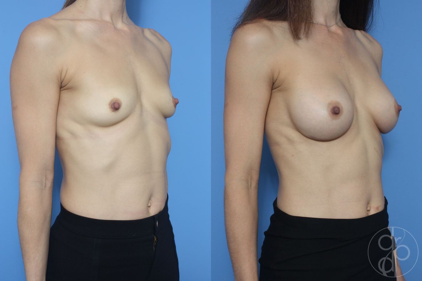 Before and after Breast Augmentation case 29795 - Angle 2