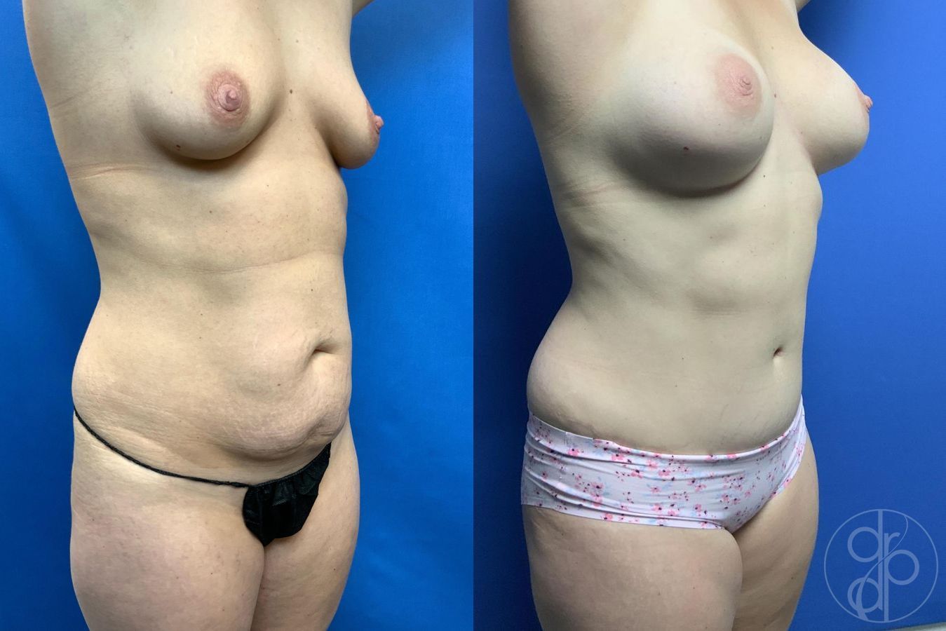 Breast Augmentation - Thumbnail 3