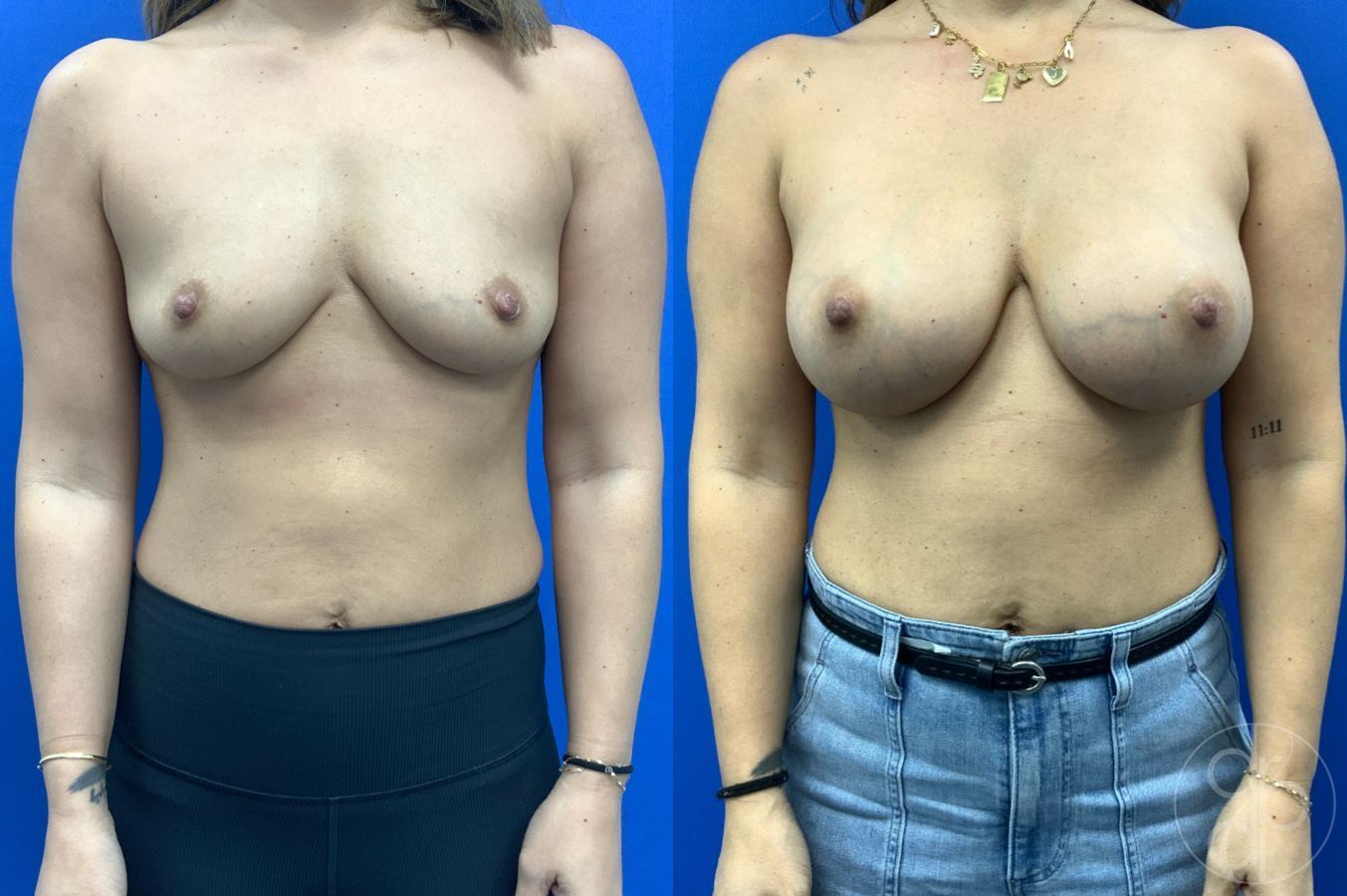Before and after Breast Augmentation case 46261